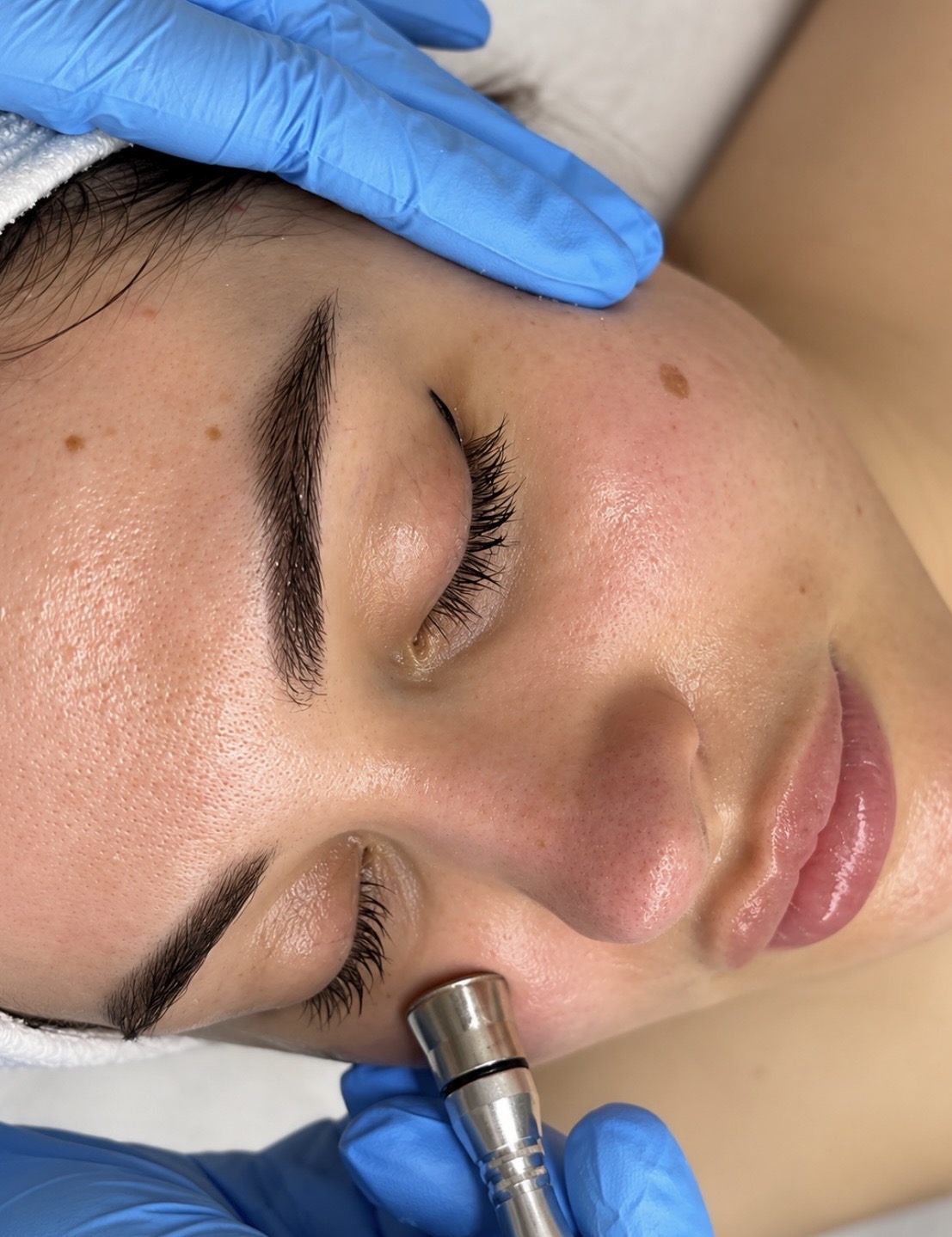 Microdermabrasion